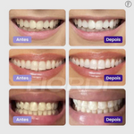 Clareador Dentário - Sérum V34™